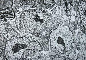 M, 80y. | mycosis fungoides